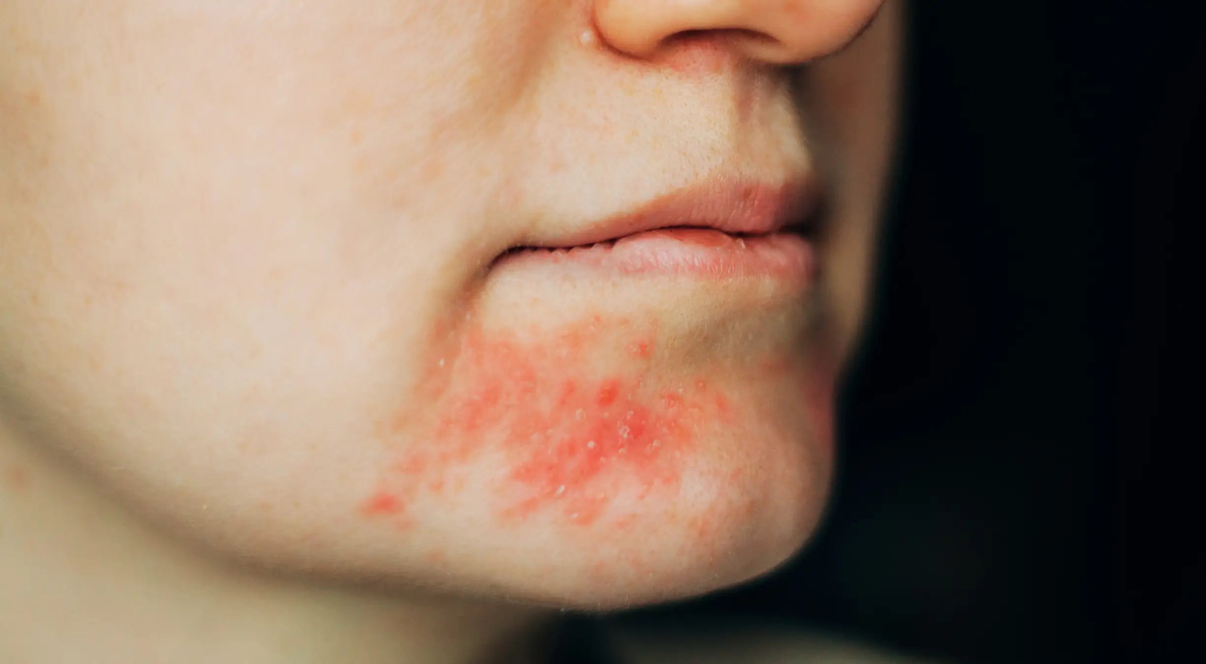 Dermatita periorală: ghid complet, declanșatori, îngrijire blândă și soluția igienică esențială